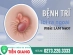 Bị lòi trĩ phải làm sao? Cách điều trị hiệu quả