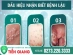 Bệnh Kim La Có Lây Không ? Chữa Ở Đâu Tốt