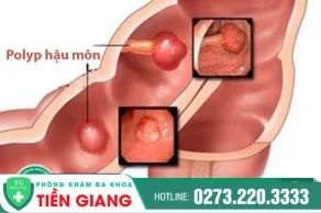 Nơi Trị Polyp Hậu Môn Hiệu Quả - Chi Phí Bình Dân