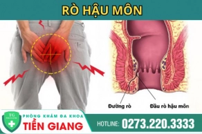 Rò Hậu Môn Là Gì ? Các Nguyên Nhân Gây Nên ?