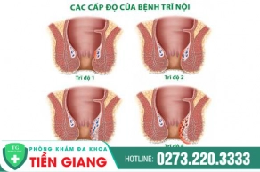 Dấu Hiệu Trĩ Nội Gồm Những Gì? Điều Trị Ra Sao?