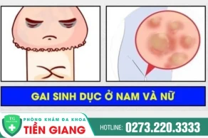 Dấu hiệu nhận biết gai sinh dục? Cách trị gai sinh dục hiệu quả