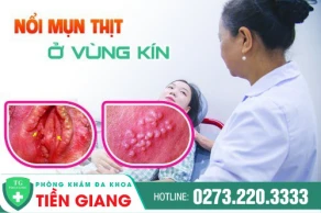 Mụn Thịt Ở Vùng Kín - Dấu Hiệu Bệnh Gì ?
