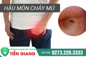 phong-kham-benh-tri-tien-giang--hau-mon-chay-mu-la-benh-gi-1375