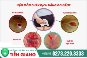 phong-kham-benh-tri-tien-giang--hau-mon-chay-dich-vang-do-dau-1377