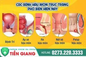 cac-benh-truc-trang-hau-mon-pho-bien-phuong-phap-dieu-tri-206