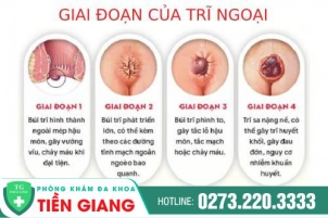mac-benh-tri-ngoai-phai-lam-sao-tim-hieu-ngay-1043
