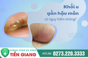 khoi-u-gan-hau-mon-co-nguy-hiem-khong-dieu-tri-nhu-nao-987