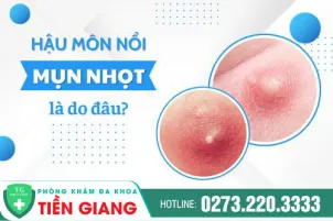 mun-nhot-hau-mon-la-gi-cung-tim-hieu-xem-nhung-thoi-quen-hang-ngay-gay-ra-nhot-hau-mon-954