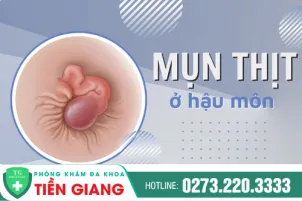 tong-hop-cac-benh-ly-co-dau-hieu-mun-thit-o-hau-mon-241
