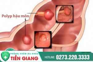 noi-tri-polyp-hau-mon-hieu-qua-chi-phi-binh-dan-239