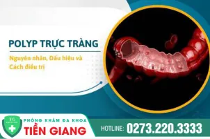 polyp-truc-trang-la-benh-gi-nguy-hiem-khong-997