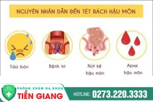 tong-quat-cac-phuong-phap-dieu-tri-trieu-chung-rach-hau-mon-617