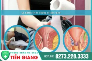tong-hop-cac-trieu-chung-ro-hau-mon-148