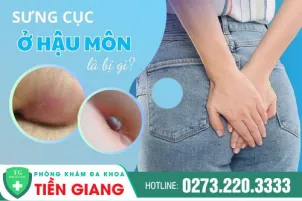 nhan-biet-sung-cuc-o-hau-mon-dau-hieu-benh-ly-nguy-hiem-1000