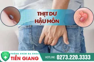 phong-kham-benh-tri-tien-giang-noi-thit-thua-hau-mon-la-bi-benh-gi-1376