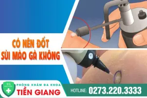 qua-trinh-dot-sui-mao-ga-co-dau-khong-phuong-phap-dieu-tri-hieu-qua-1113