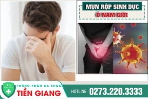 mun-rop-sinh-duc-nam-nhung-dieu-can-biet-1058