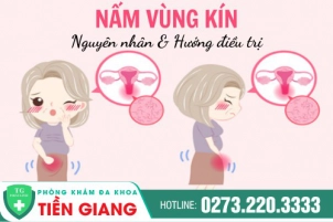 nam-vung-kin-nguyen-nhan-do-dau-cach-dieu-tri-hieu-qua-hien-nay-1067