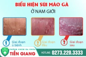 sui-mao-ga-o-nam-co-bieu-hien-gi-cach-tri-benh-sui-mao-ga-o-nam-1437