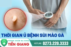 thoi-gian-u-benh-sui-mao-ga-bao-lau-dieu-tri-cach-nao-hieu-qua-1431