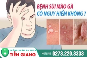 benh-sui-mao-ga-co-nguy-hiem-khong-cach-dieu-tri-sui-mao-ga-hieu-qua-1434