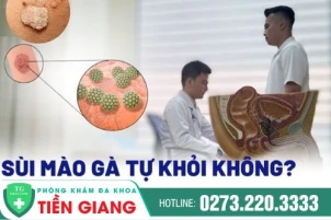 sui-mao-ga-co-tu-khoi-khong-tri-benh-sui-mao-ga-cach-nao-hieu-qua-1436
