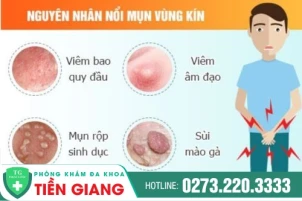 noi-mun-vung-kin-la-bi-benh-gi-phuong-phap-nao-dieu-tri-hieu-qua-1440