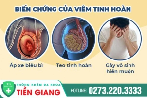 viem-tinh-hoan-co-anh-huong-gi-khong-cach-chua-viem-tinh-hoan-hieu-qua-874
