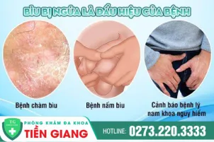 phong-kham-da-khoa-tien-giang-dieu-tri-biu-bi-ngua-bang-phuong-phap-hien-dai-822