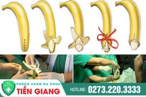 cat-bao-quy-dau-tien-giang-dia-chi-phong-kham-cat-bao-quy-dau-uy-tin-tien-giang-1370