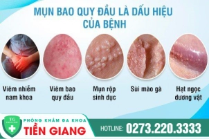 bao-quy-dau-noi-mun-co-phai-dau-hieu-benh-nguy-hiem-591