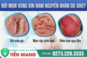 dieu-tri-duong-vat-noi-mun-tien-giang-duong-vat-noi-mun-la-benh-gi-1382