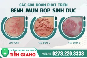 tong-quan-ve-mun-rop-sinh-duc-nguyen-nhan-va-cach-dieu-tri-hieu-qua-1388