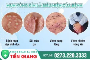 cau-nho-bi-noi-mun-thit-la-dau-hieu-benh-gi-tac-hai-va-cach-dieu-tri-hieu-qua-1134