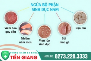 bo-phan-sinh-duc-bi-ngua-noi-tham-kin-kho-noi-cua-nam-gioi-tim-hieu-nguyen-nhan-va-phuong-phap-khac-phuc-nhe!-728