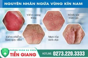 nguyen-nhan-gay-ngua-dau-rat-vung-kin-nam-cach-tri-ngua-vung-kin-nam-hieu-qua-1255