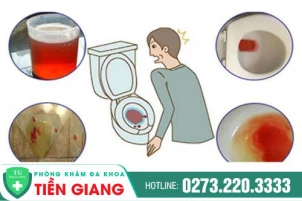 tieu-ra-mau-co-nguy-hiem-khong-nguyen-nhan-va-cach-dieu-tri-1395