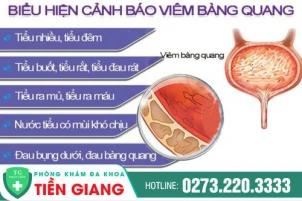 cach-chua-tri-viem-bang-quang-an-toan-hieu-qua-hien-nay-1436