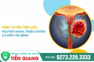 viem-tien-liet-tuyen-la-gi-phuong-phap-dieu-tri-viem-tuyen-tien-liet-hieu-qua-1161