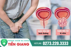 viem-tuyen-tien-liet-co-nguy-hiem-khong-cach-tri-viem-tuyen-tien-liet-hieu-qua-1155
