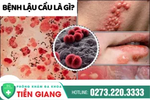 tong-quan-ve-benh-lau-cau-343