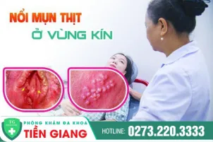 mun-thit-o-vung-kin-dau-hieu-benh-gi-480