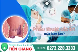 thoi-gian-phau-thuat-cat-tri-mat-bao-lau-khi-nao-lanh-948