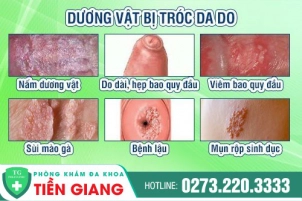 cac-nguyen-nhan-gay-ra-tinh-trang-duong-vat-bi-troc-da-444