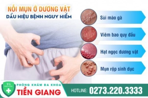 top-cac-phuong-phap-tri-mun-duong-vat-nhanh-khoi-561