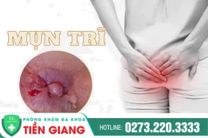 mun-tri-la-do-dau-cach-chua-tri-moi-hien-nay-250