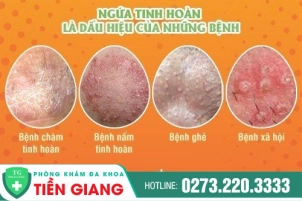 trieu-chung-ngua-tinh-hoan-o-nam-gioi-co-phai-benh-nguy-hiem-chua-tri-nhu-nao-358
