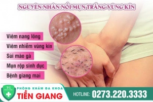 noi-mun-trang-o-vung-kin-nu-co-dang-lo-ngai-478