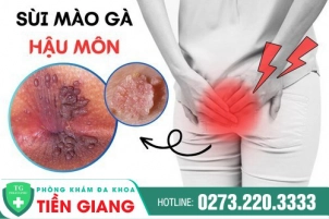 sui-mao-ga-hau-mon-bien-phap-dieu-tri-176